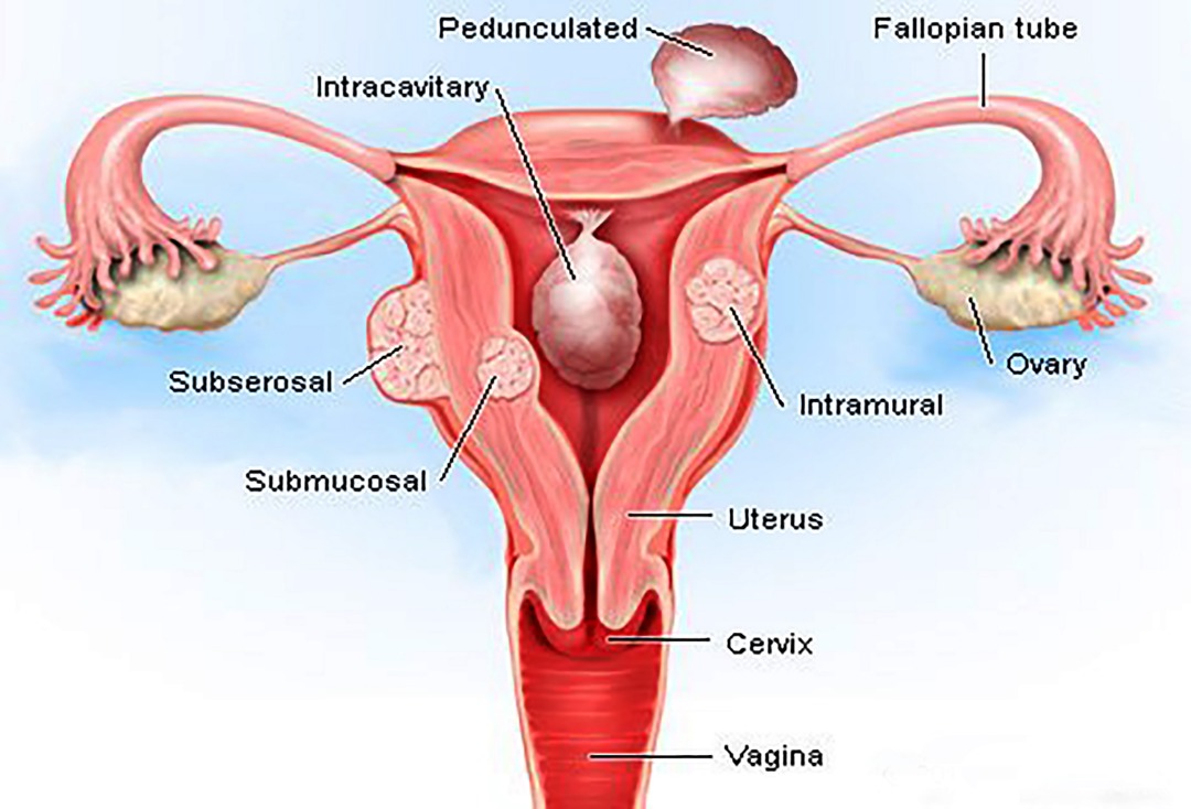 Pedunculated Uterine Fibroids